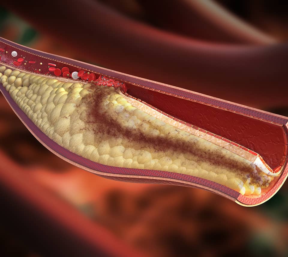 Illustration of a blood vessel with plaque buildup